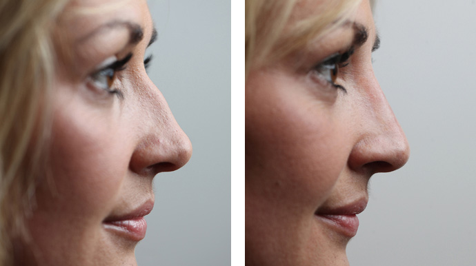 nose surgical non fillers job results shaping procedure milo clinic