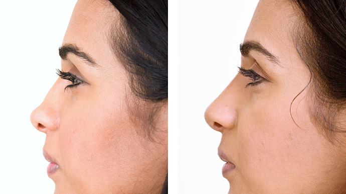 Botox Nose Slimming